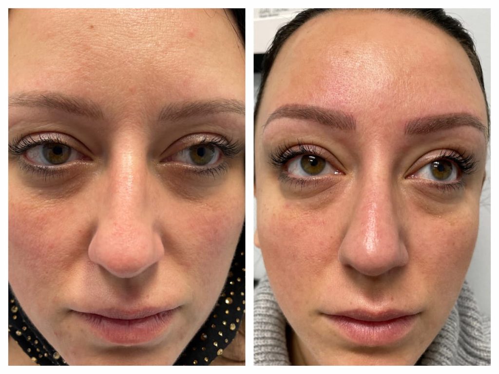 non-surgical-rhinoplasty (3)