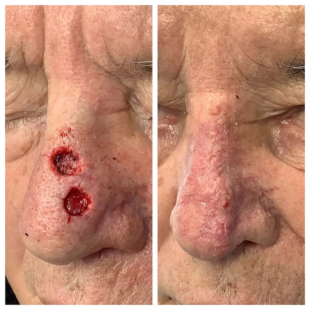 nose-surgery-before-and-after (1)