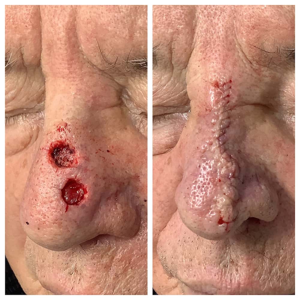 nose-surgery-before-and-after (2)