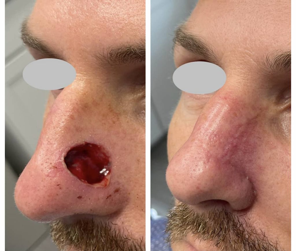 nose-surgery-before-and-after (4)
