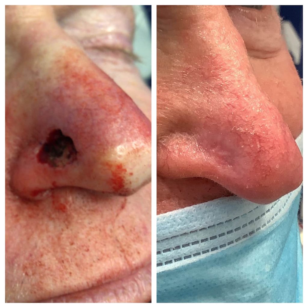 nose-surgery-before-and-after (5)