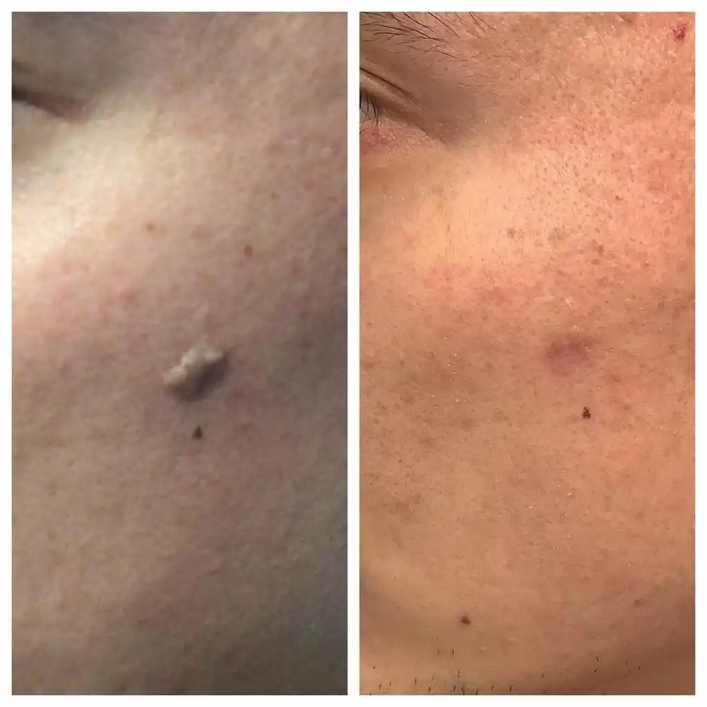 seborrheic-keratosis-removal-before-and-after (2)