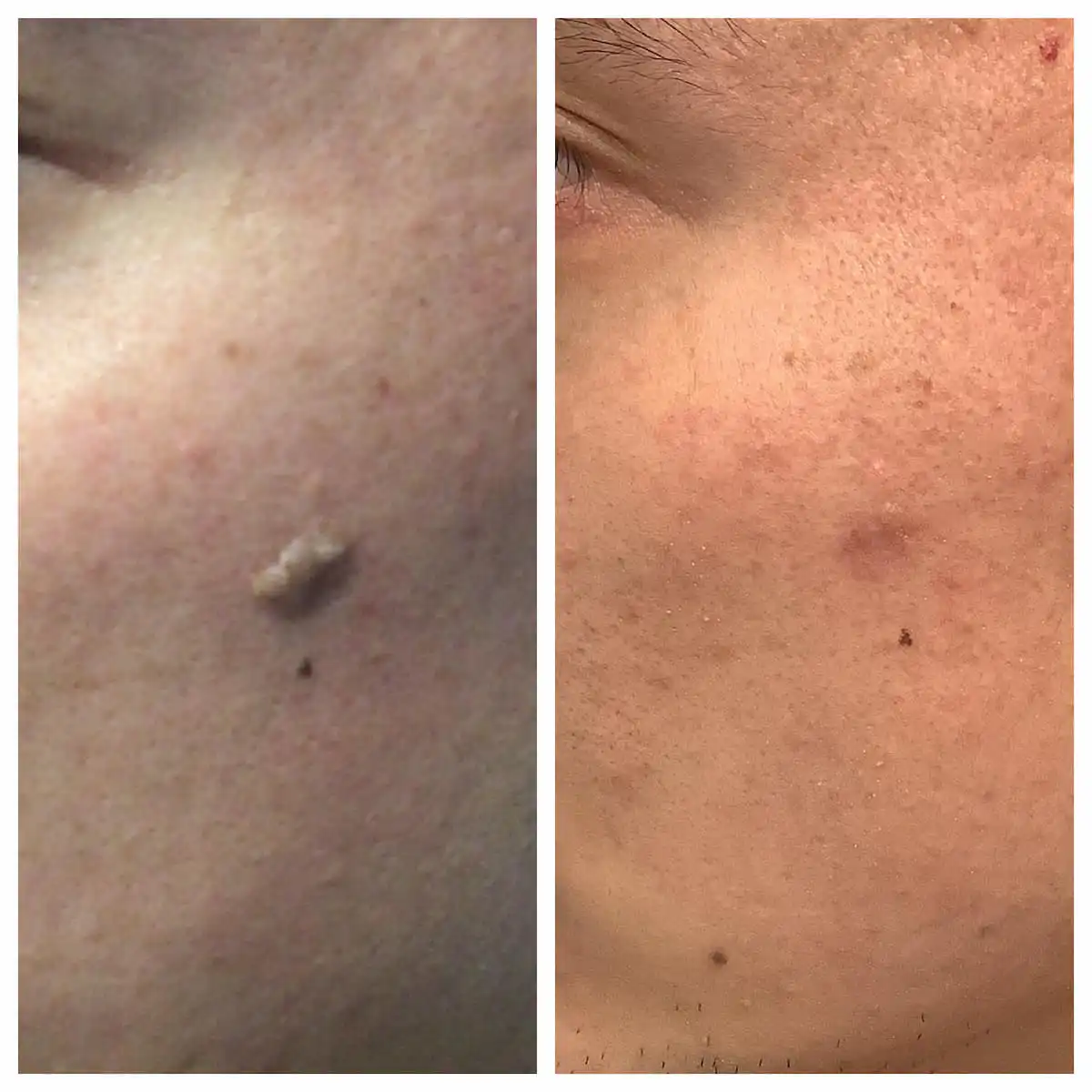 Seborrheic keratosis removal before and after — St. Louis Dermatology & Cosmetic Surgery