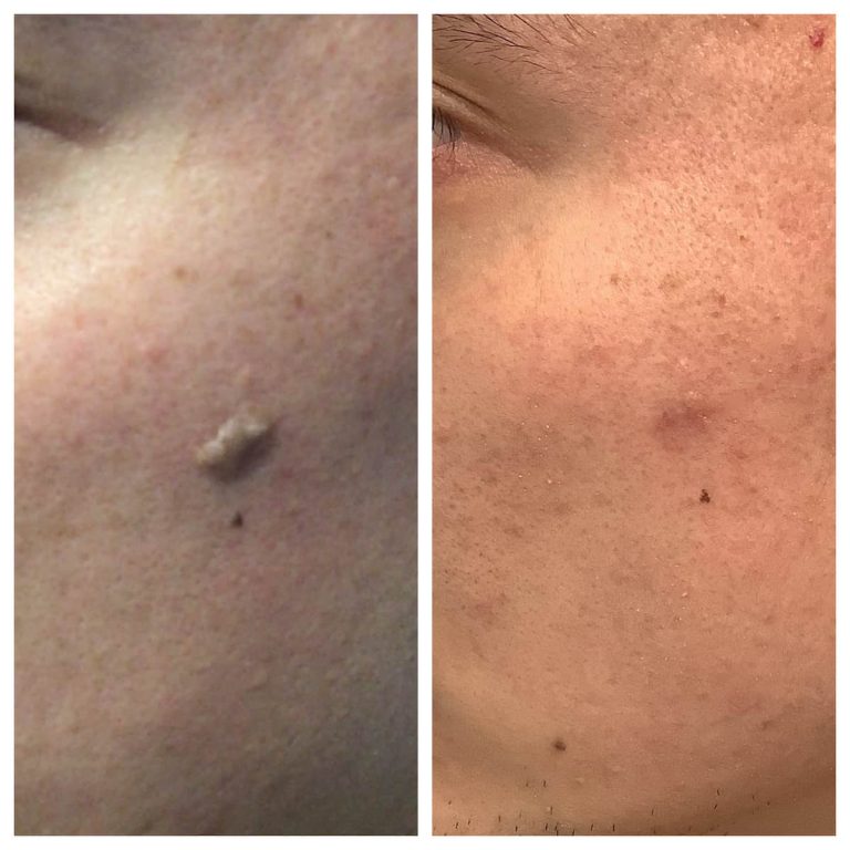 Seborrheic Keratosis Removal Before And After St Louis Dermatology