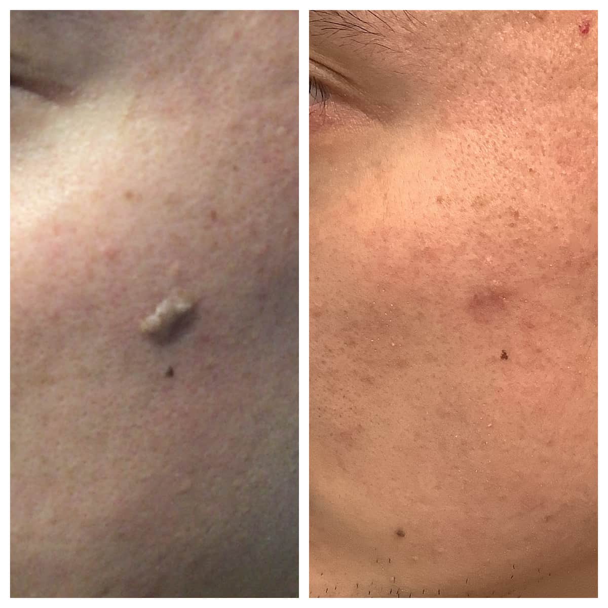Seborrheic Keratosis Removal Clinic