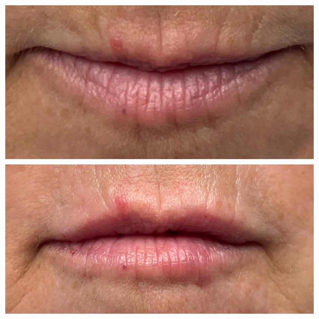 st-louis-lip-filler (1)