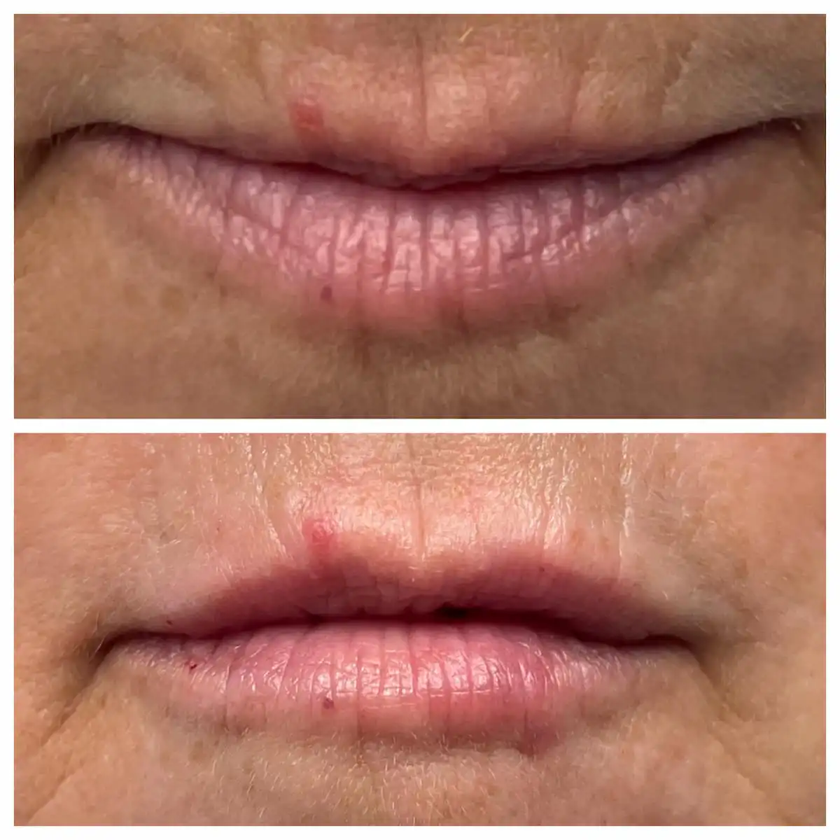 Lip filler before and after, mature lips — St. Louis Dermatology & Cosmetic Surgery