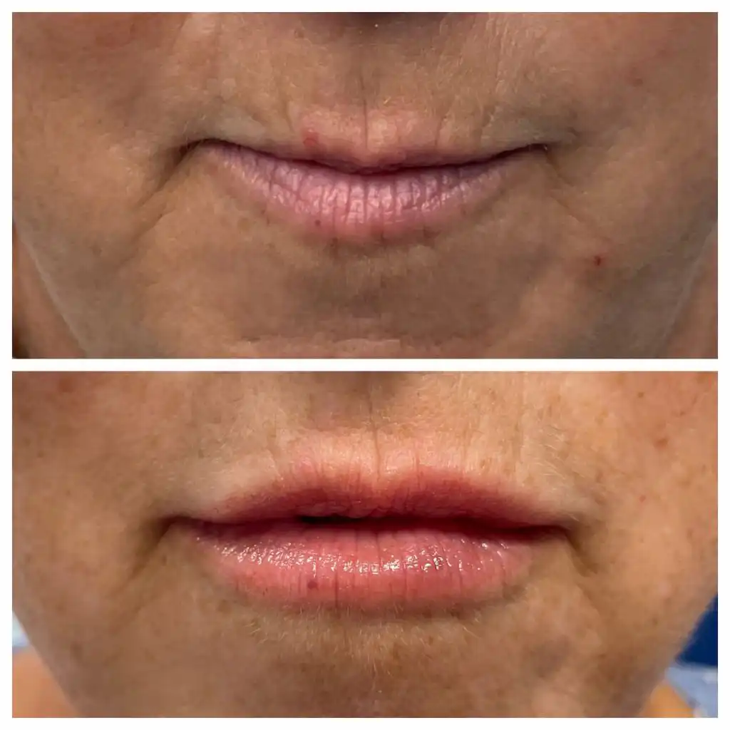 st-louis-lip-filler (2)
