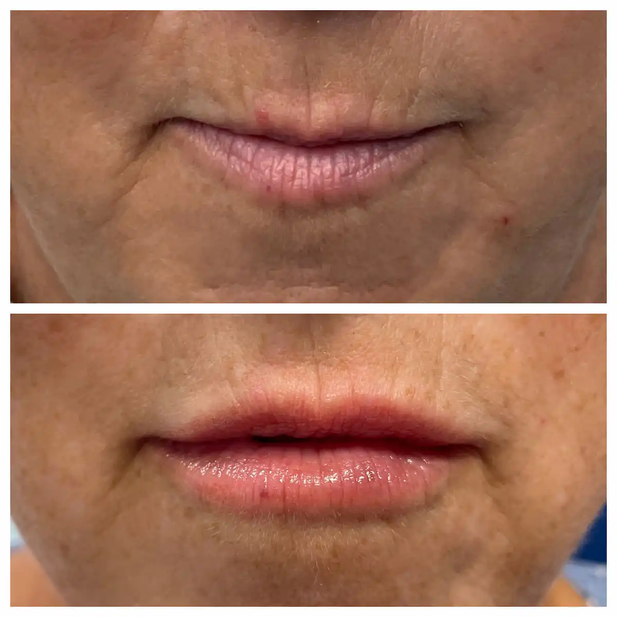 Lip filler before and after, mature lips — St. Louis Dermatology & Cosmetic Surgery