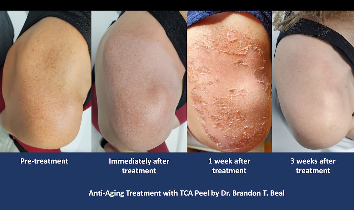 tca-peel-sun-spots-before-and-after