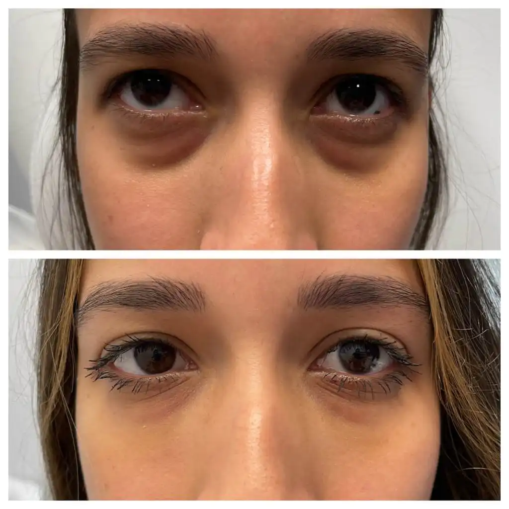 Tear trough filler before and after softening under-eye hollows, patient of Dr. Brandon T. Beal