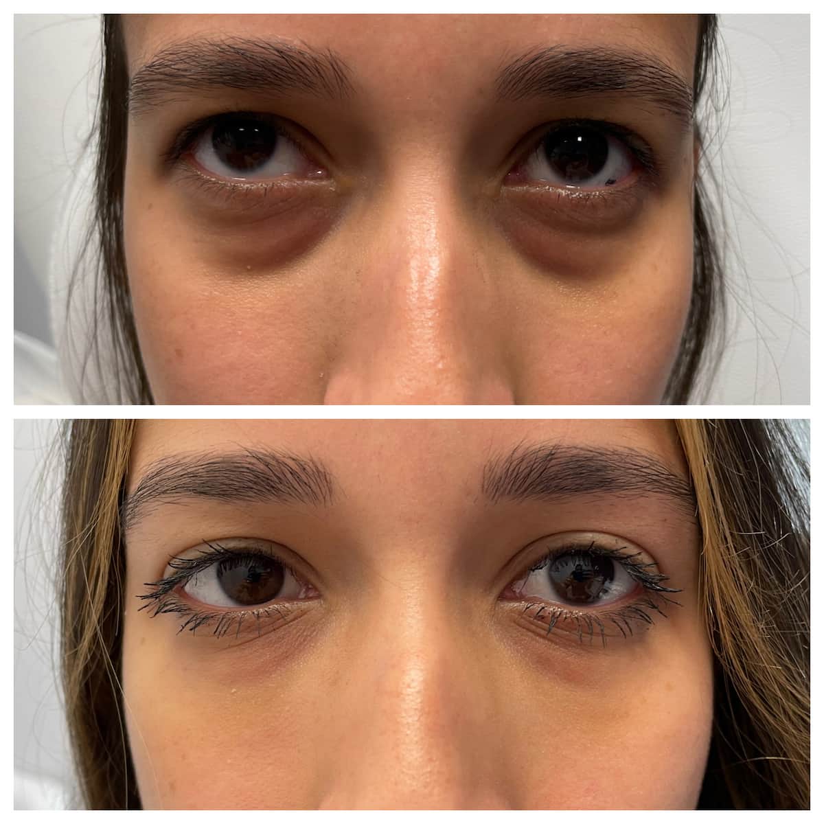 Tear trough under-eye filler before and after — St. Louis Dermatology & Cosmetic Surgery