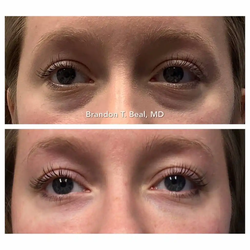 tear-trough-filler (2)