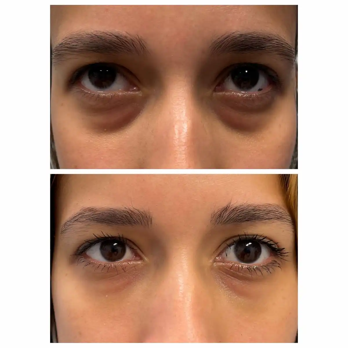 Tear trough under-eye filler before and after — St. Louis Dermatology & Cosmetic Surgery