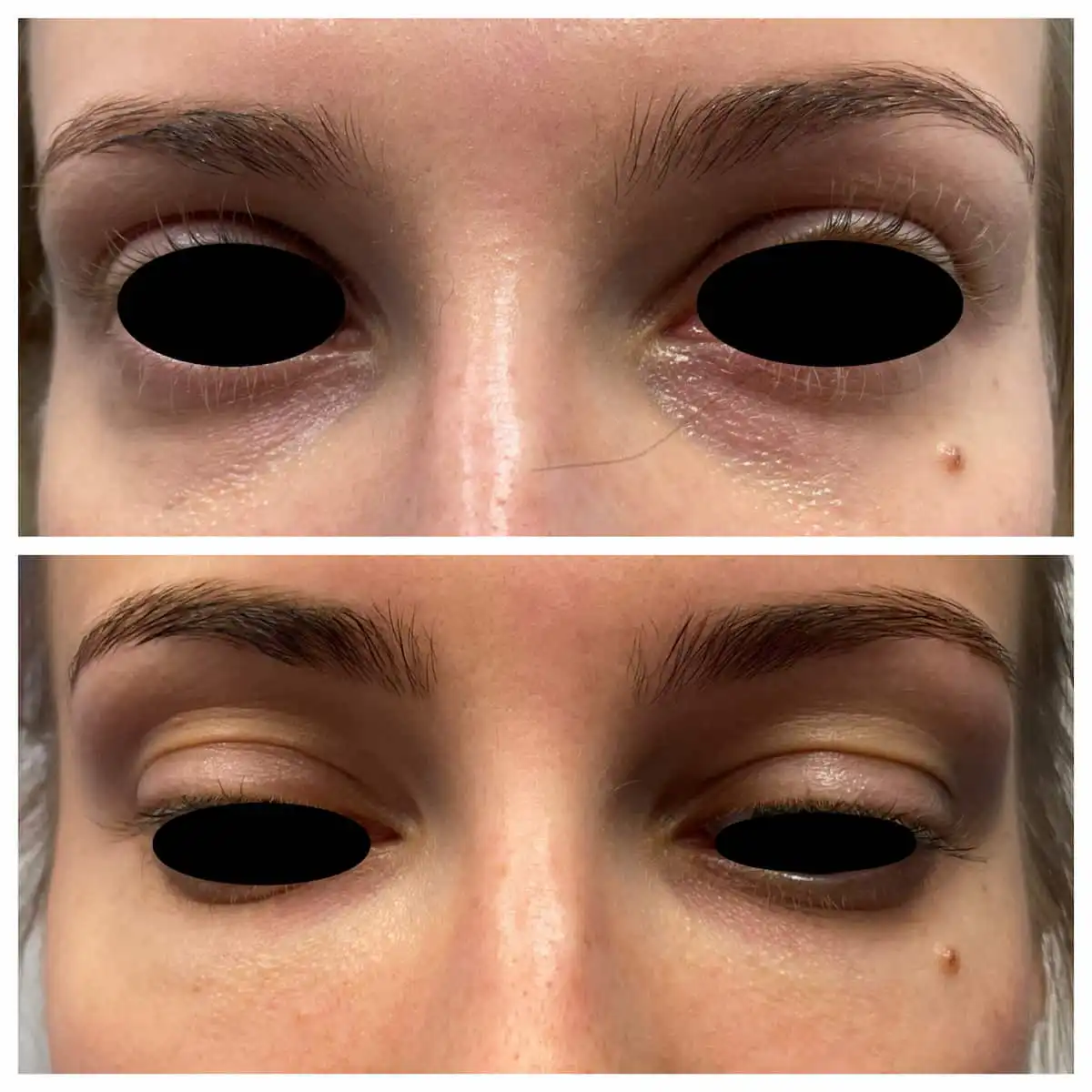 Tear trough under-eye filler before and after — St. Louis Dermatology & Cosmetic Surgery