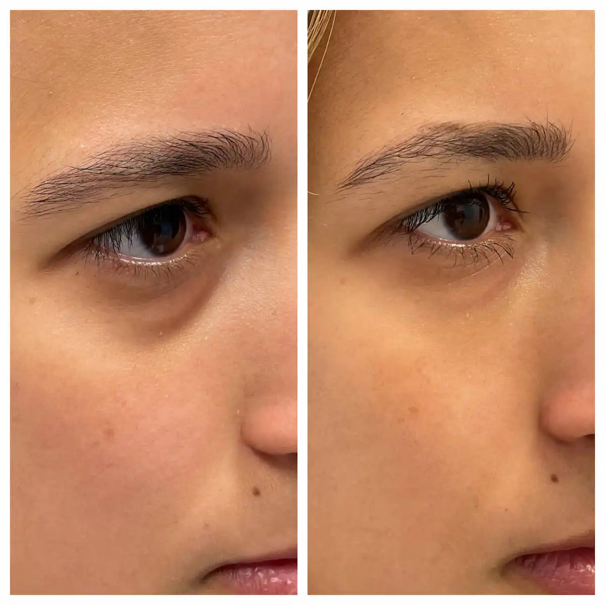 Tear trough under-eye filler before and after, oblique view — St. Louis Dermatology & Cosmetic Surgery