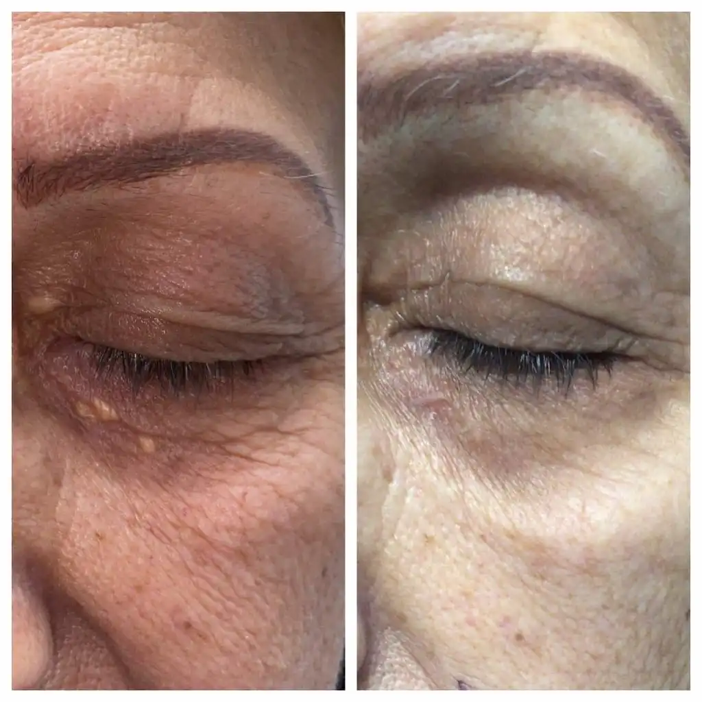 Xanthelasma removal before and after, side view of the eyelid — St. Louis Dermatology & Cosmetic Surgery
