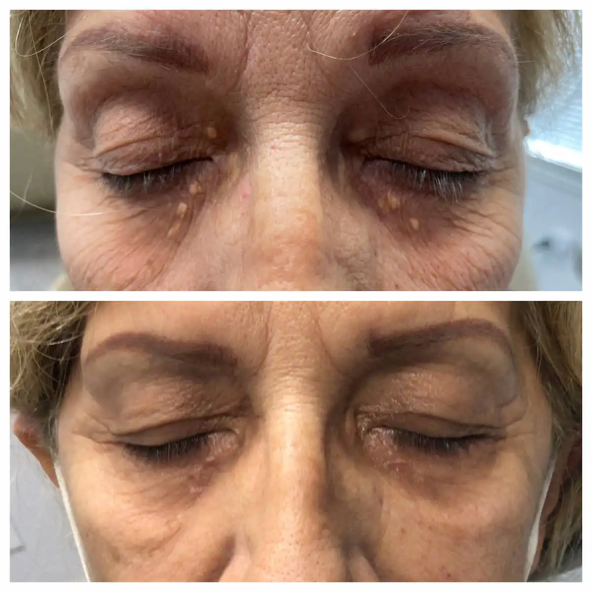Xanthelasma removal before and after, front view — St. Louis Dermatology & Cosmetic Surgery