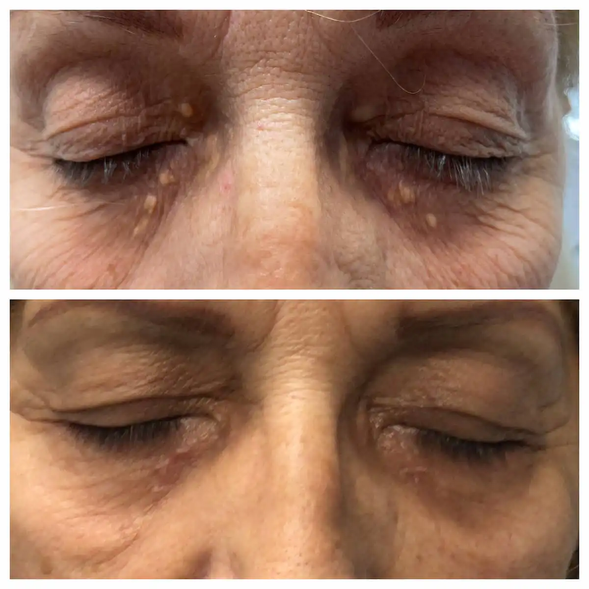 Xanthelasma removal before and after, additional view — St. Louis Dermatology & Cosmetic Surgery
