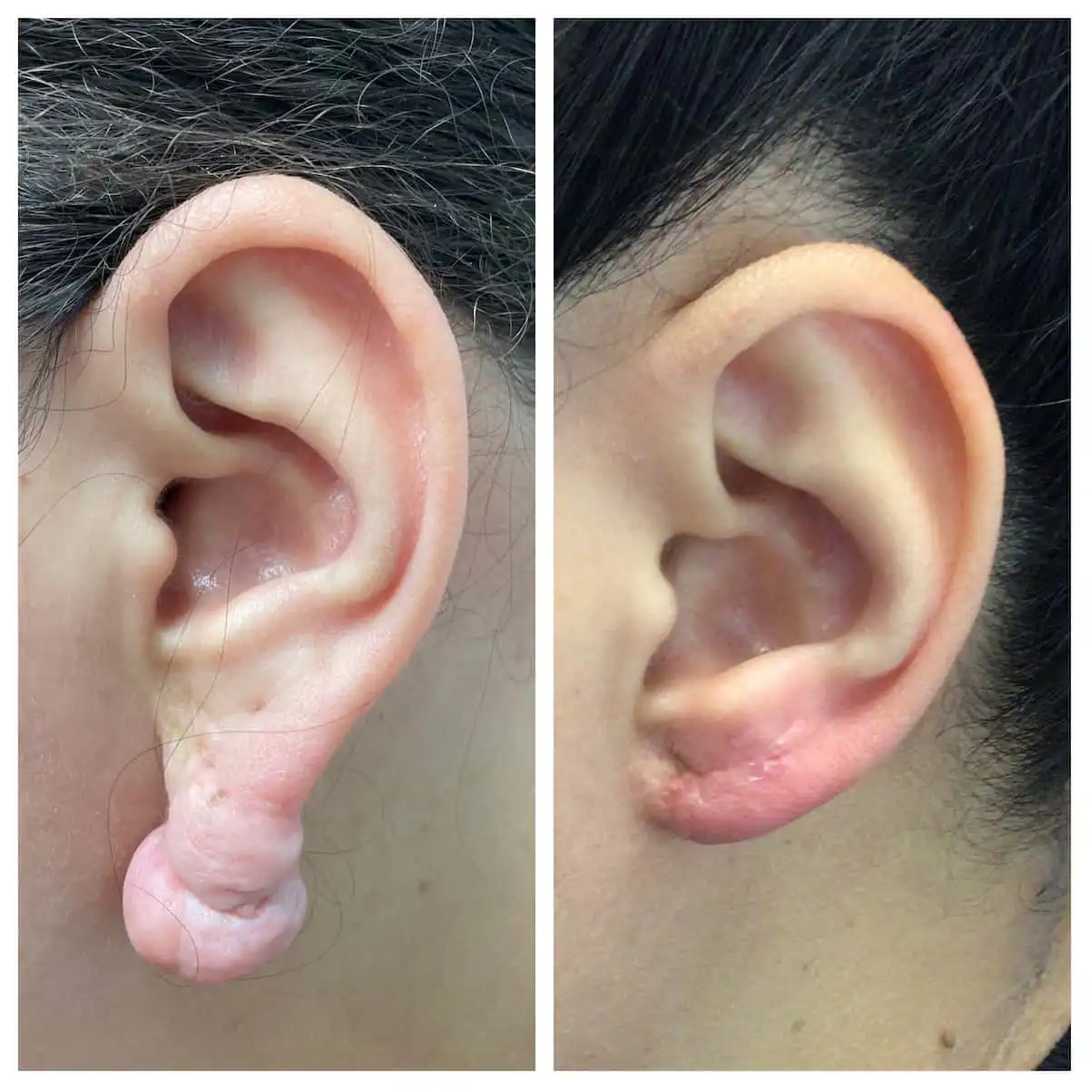 Torn earlobe repair before and after — St. Louis Dermatology & Cosmetic Surgery