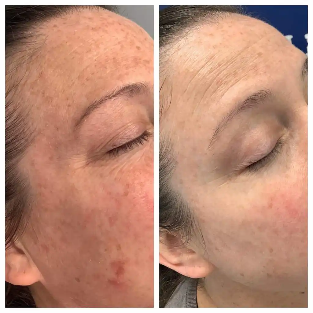Blue Light Treatment for Brown Spots Before and After