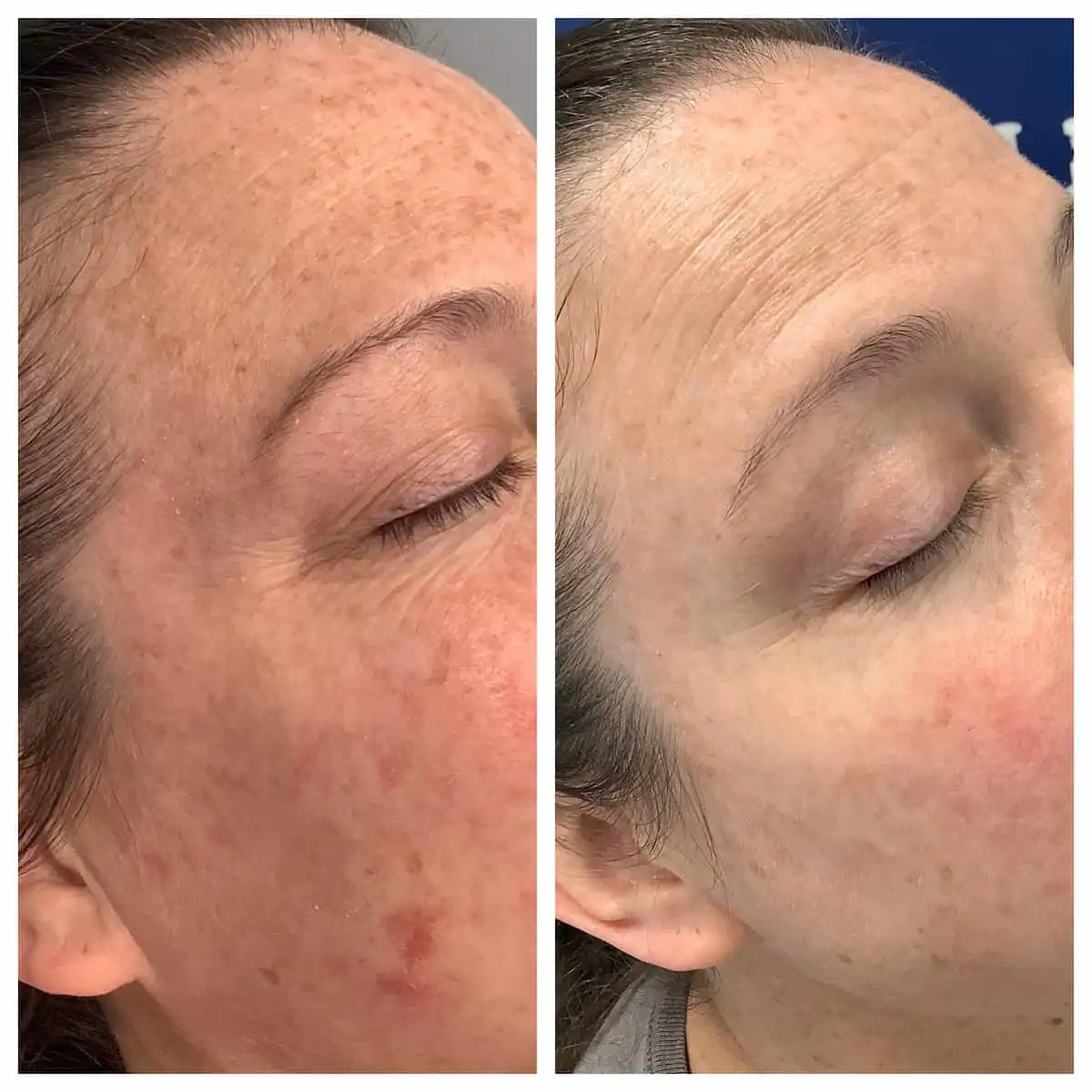 Photodynamic therapy for brown spots and sun damage before and after — St. Louis Dermatology & Cosmetic Surgery