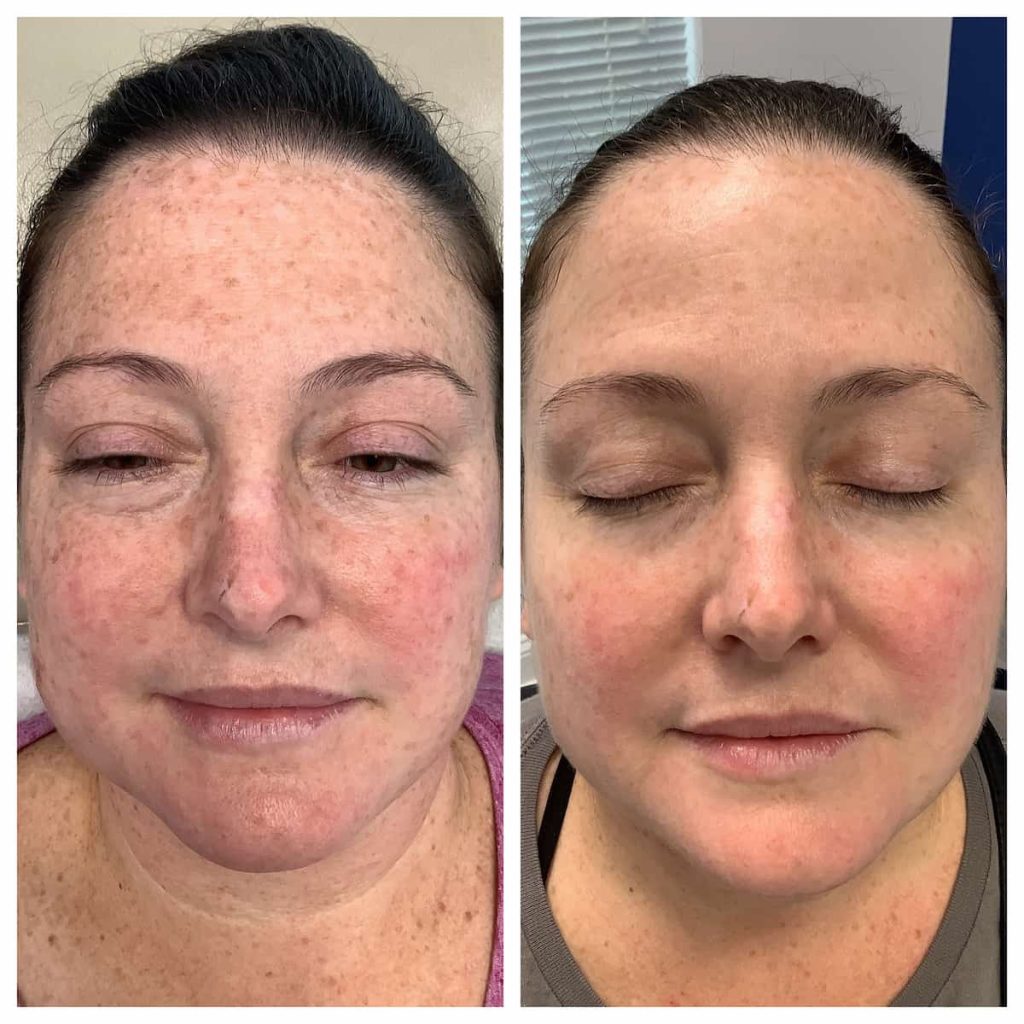 Blue Light Treatment for Brown Spots St. Louis