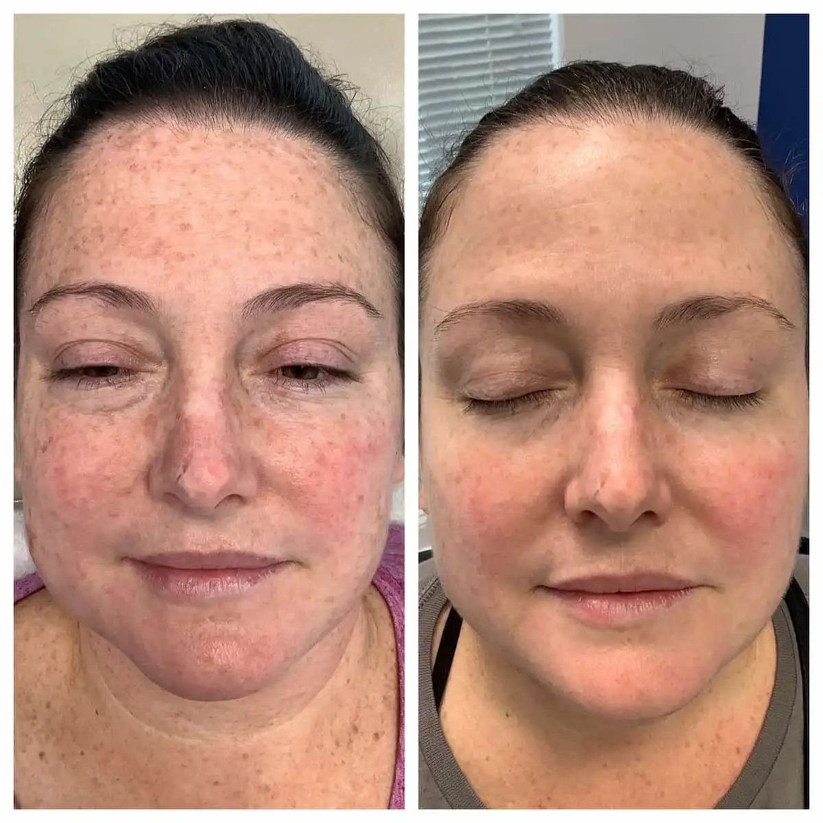 Photodynamic therapy for brown spots before and after, second view — St. Louis Dermatology & Cosmetic Surgery
