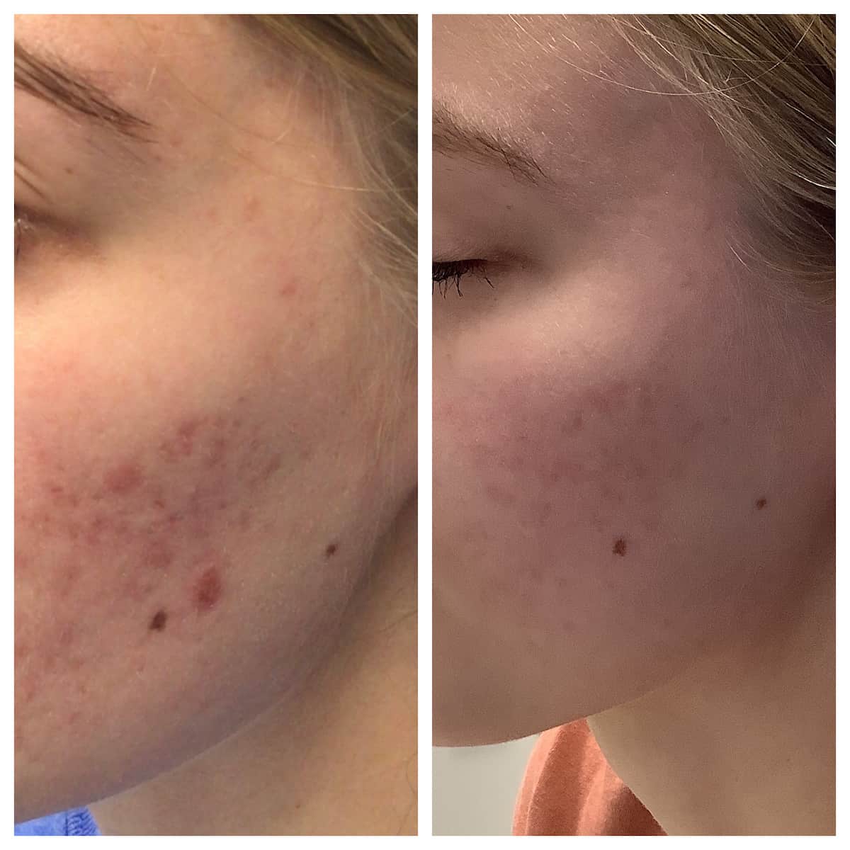 Cheek Acne Cure STL