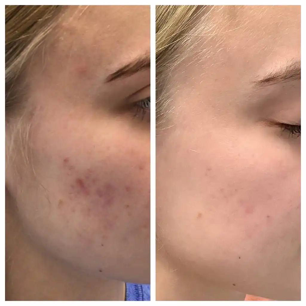 Cheek Acne Treatment