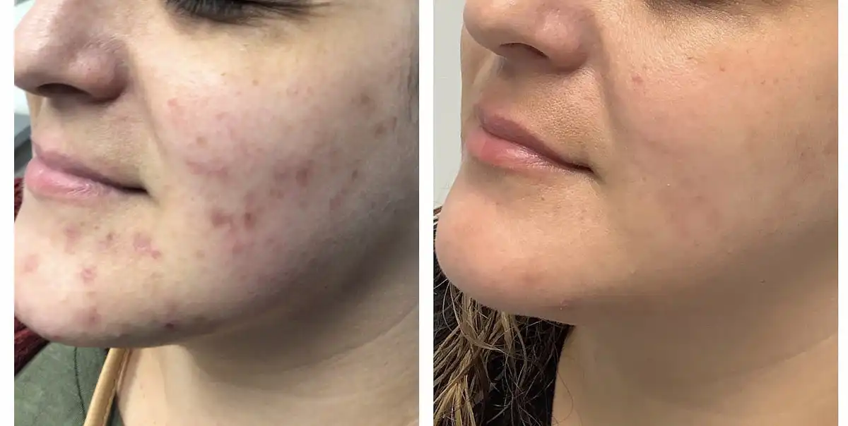 Cheek and jawline acne treatment before and after — St. Louis Dermatology & Cosmetic Surgery