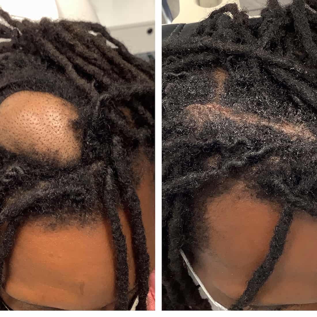 Cyst on scalp before and after
