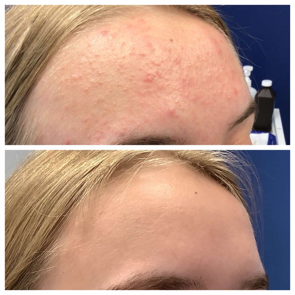 Forehead Acne Cure STL