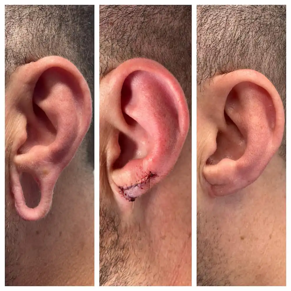 Gauged earlobe repair before and after — St. Louis Dermatology & Cosmetic Surgery