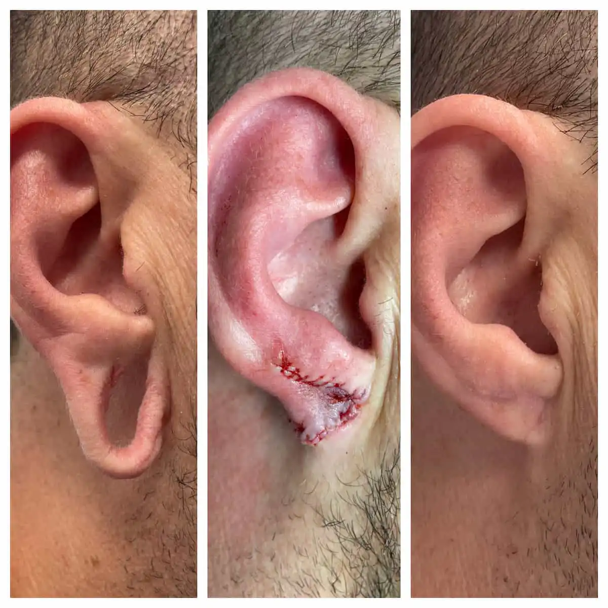 Gauged earlobe repair before and after — St. Louis Dermatology & Cosmetic Surgery