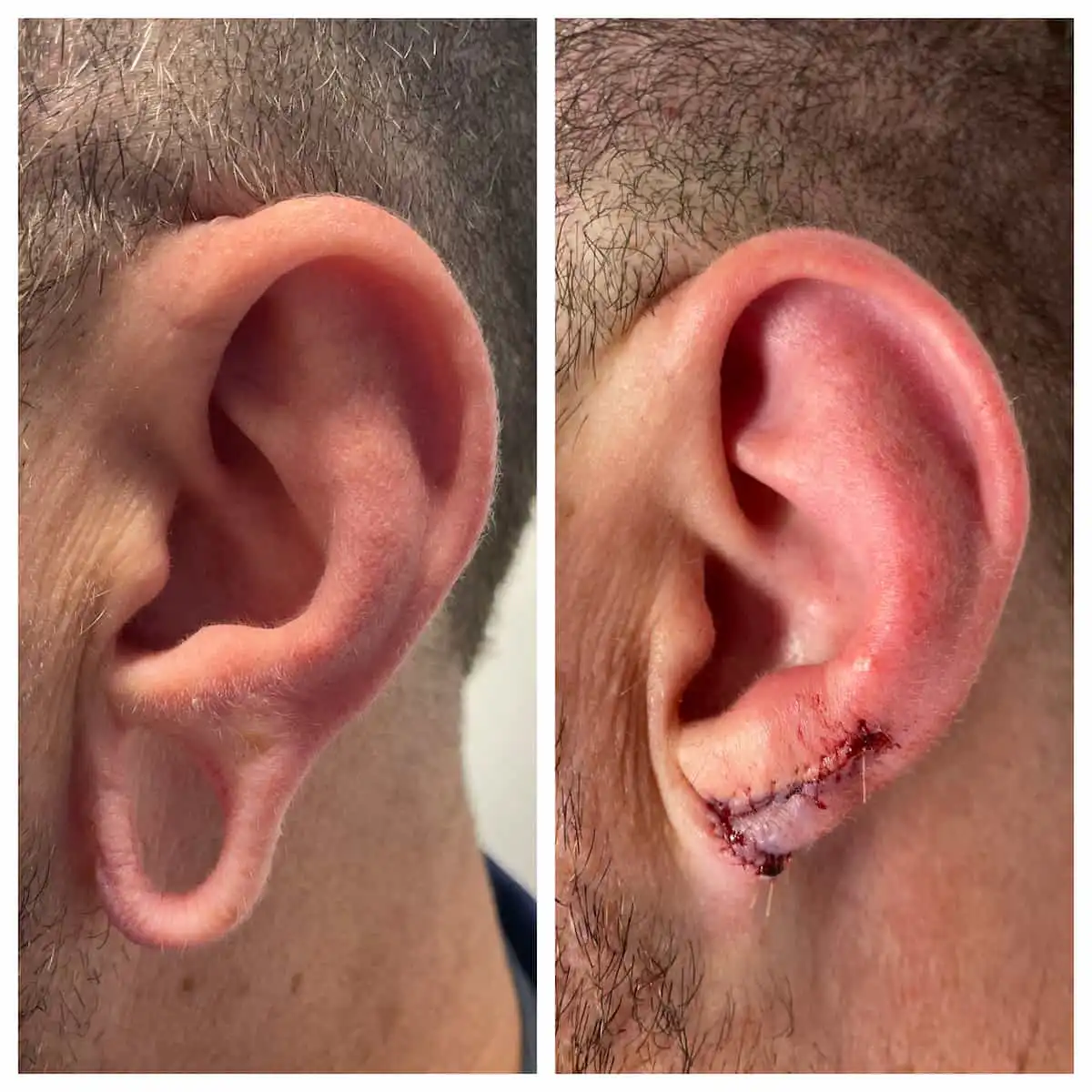 Gauged earlobe repair before and after — St. Louis Dermatology & Cosmetic Surgery