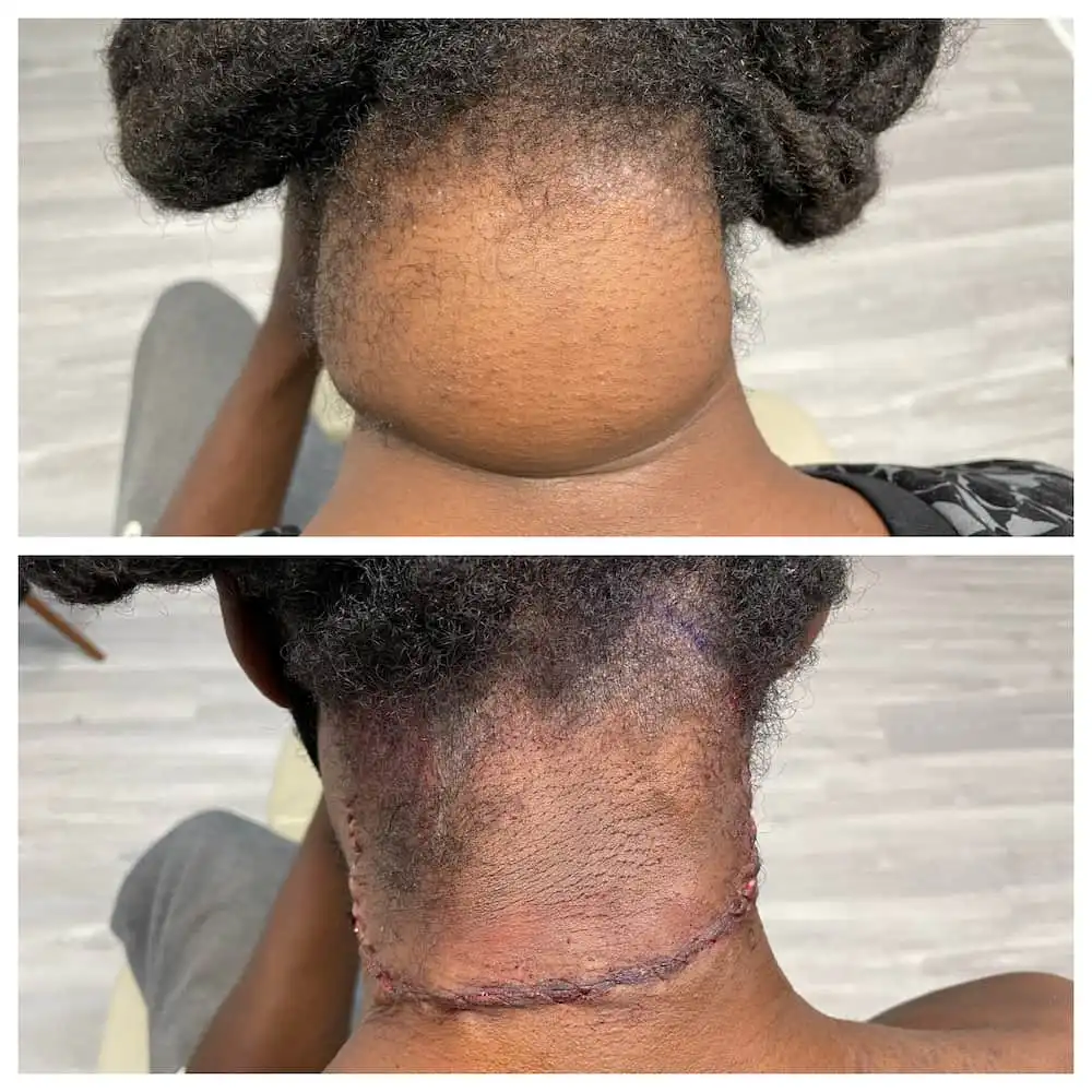 Neck lipoma removal before and after — St. Louis Dermatology & Cosmetic Surgery