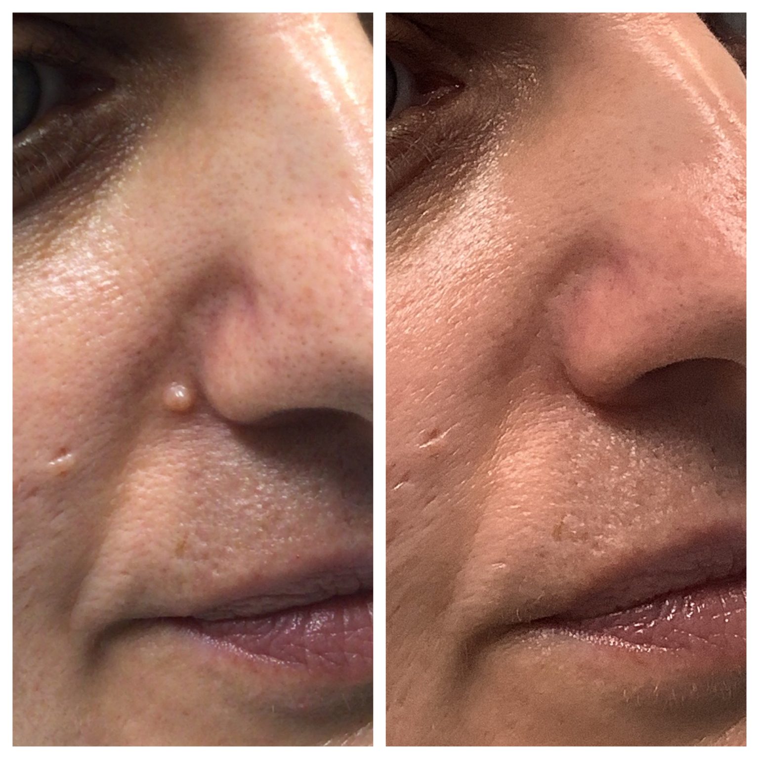 The Ultimate Guide to Cosmetic Mole Removal