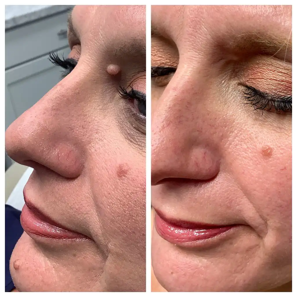 Nose Mole Removal STL 2