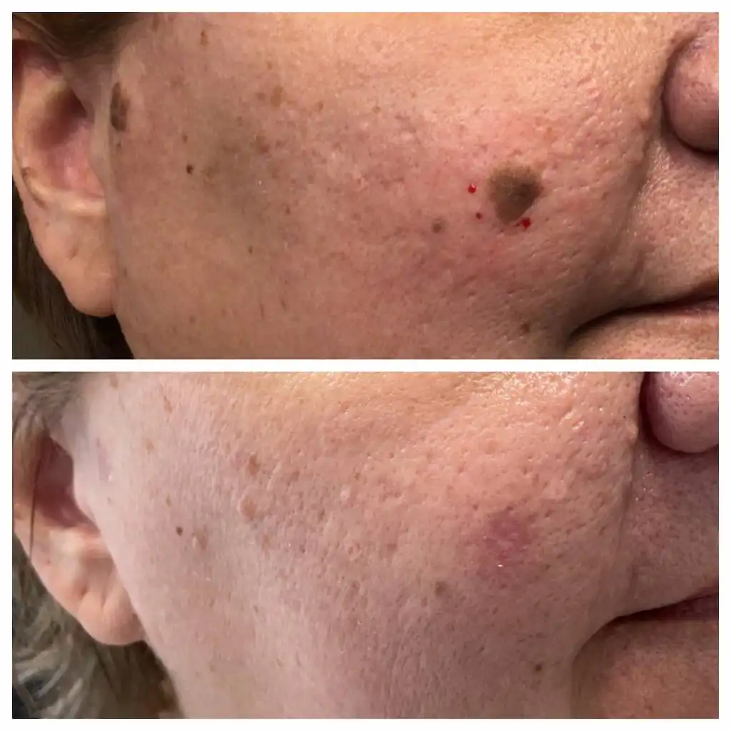 Seborrheic Keratosis Removal Mole Removal