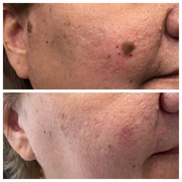 Seborrheic Keratosis Removal Before and After St. Louis Dermatology