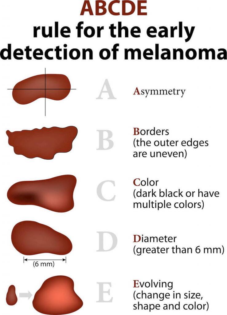 abcde-melenoma-739x1024