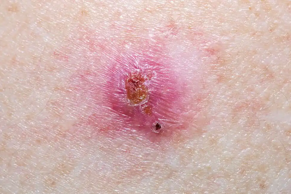 basal-cell-carcinoma-stl