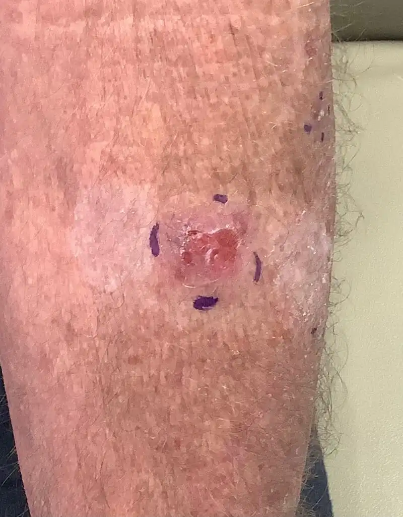 basal-cell-skin-cancer