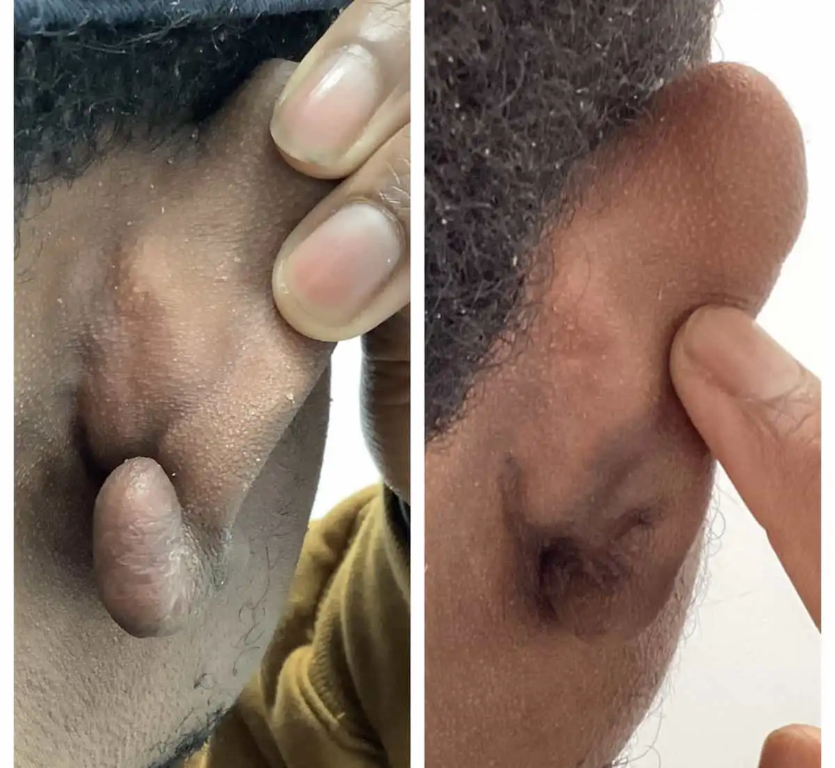 Gauged earlobe repair before and after — St. Louis Dermatology & Cosmetic Surgery
