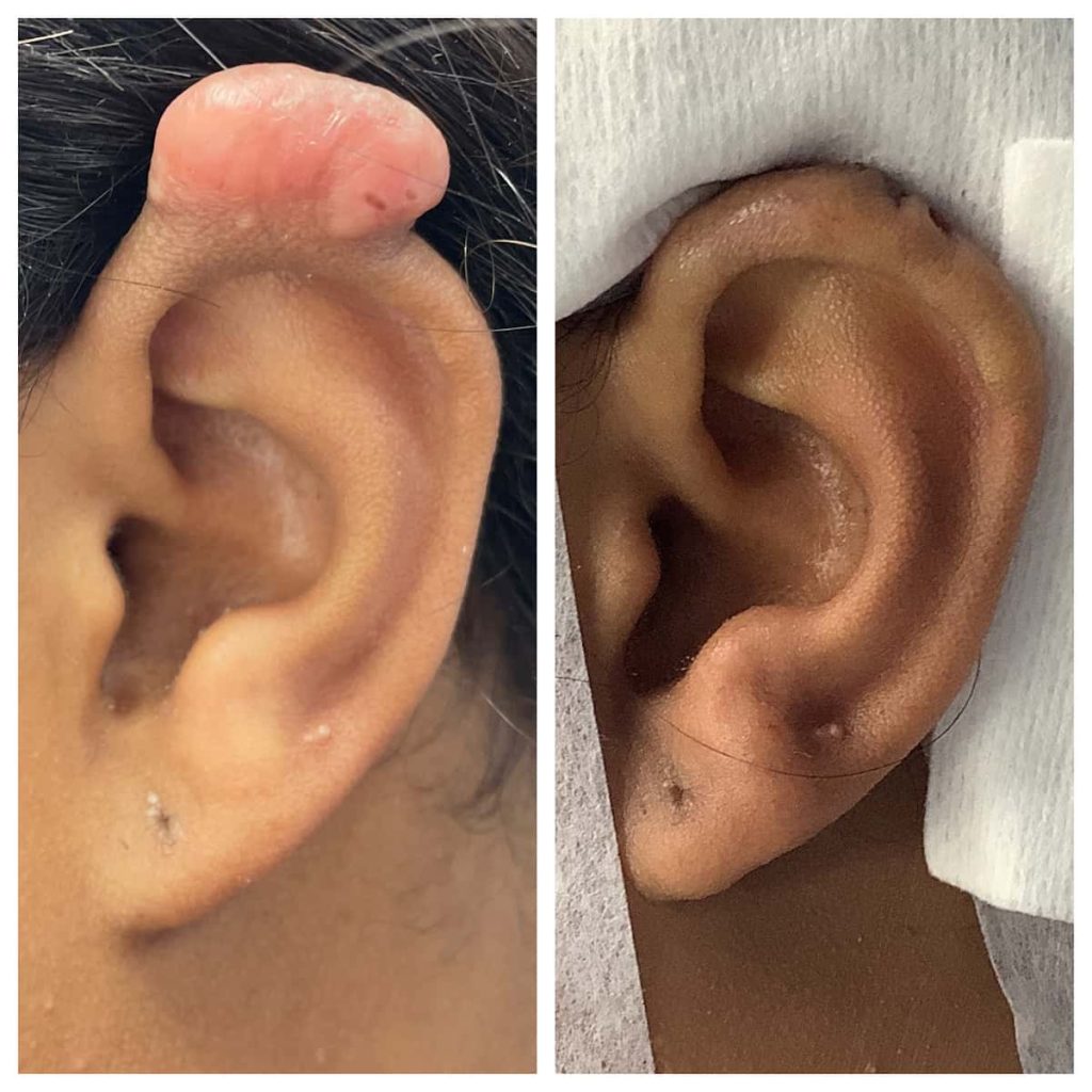 earlobe-repair (3)