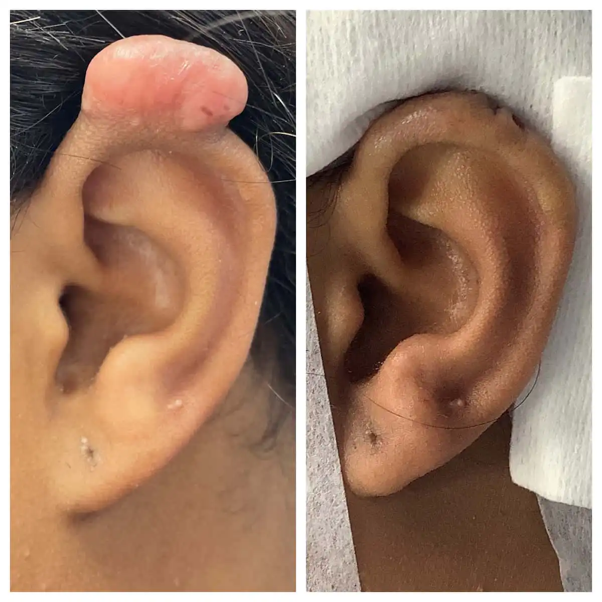 Gauged earlobe repair before and after — St. Louis Dermatology & Cosmetic Surgery