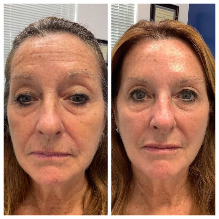 Comprehensive Facial Rejuvenation Before and After - St. Louis Dermatology & Cosmetic Surgery