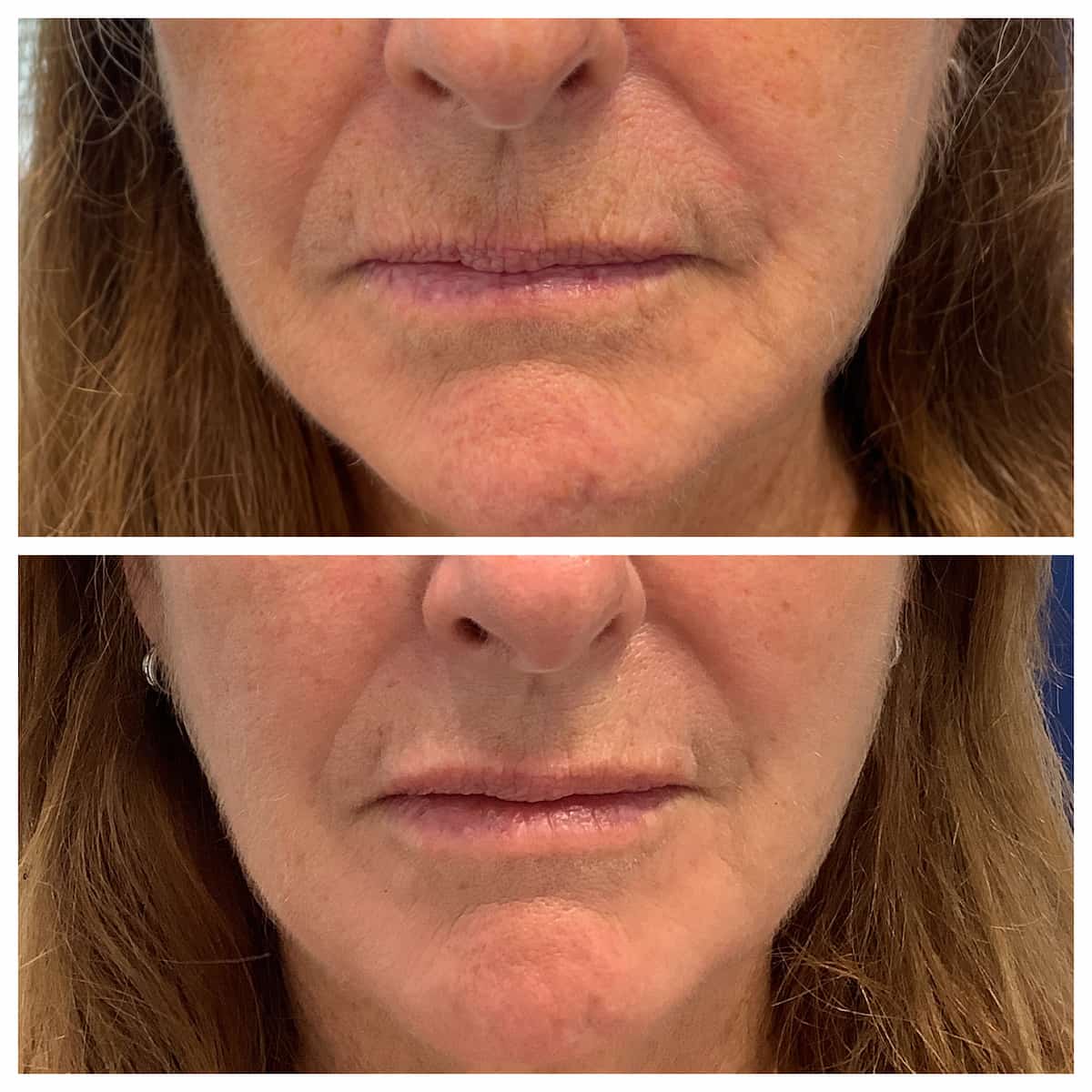 Lip and perioral filler before and after — St. Louis Dermatology & Cosmetic Surgery