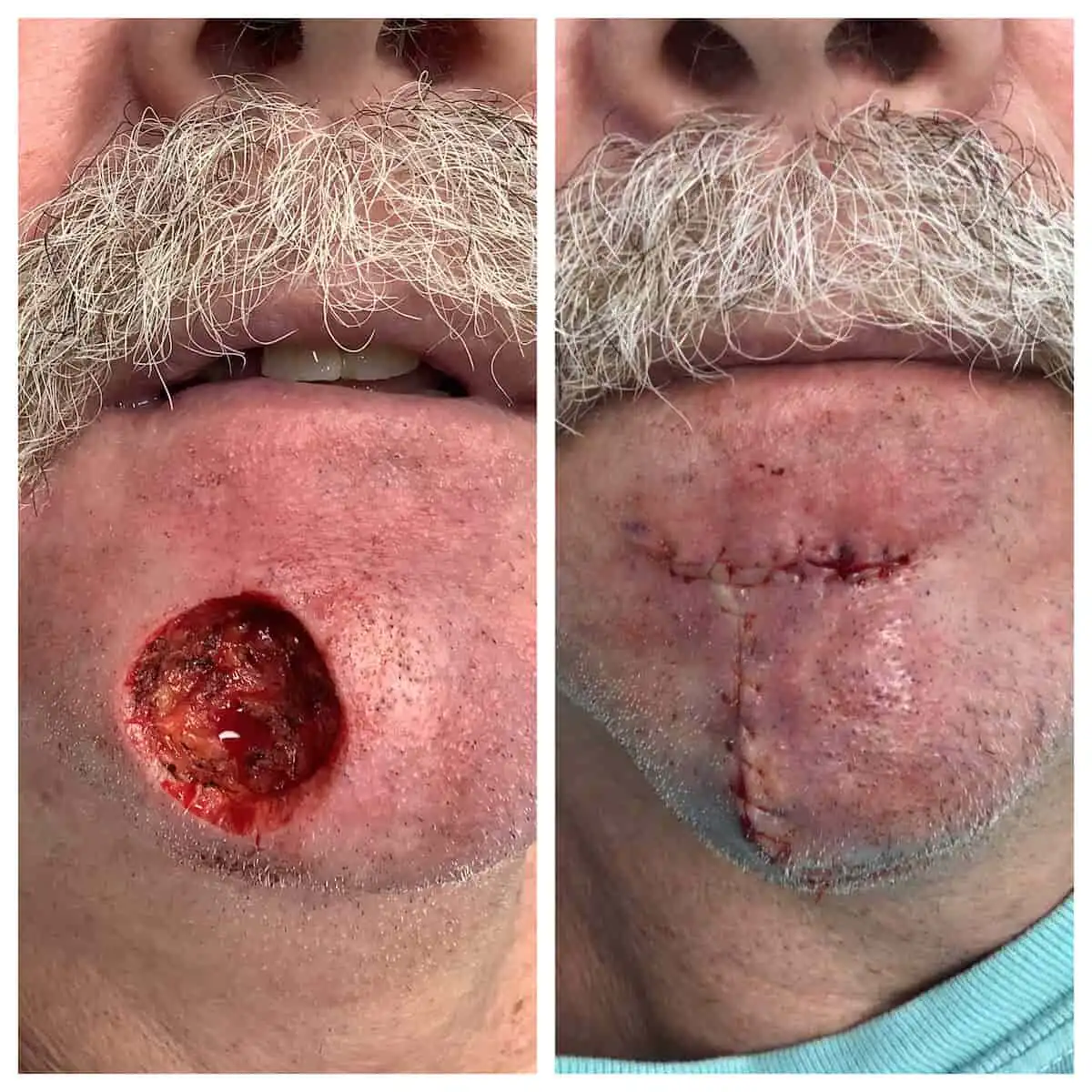 Upper lip Mohs surgery and reconstruction, before and after — St. Louis Dermatology & Cosmetic Surgery